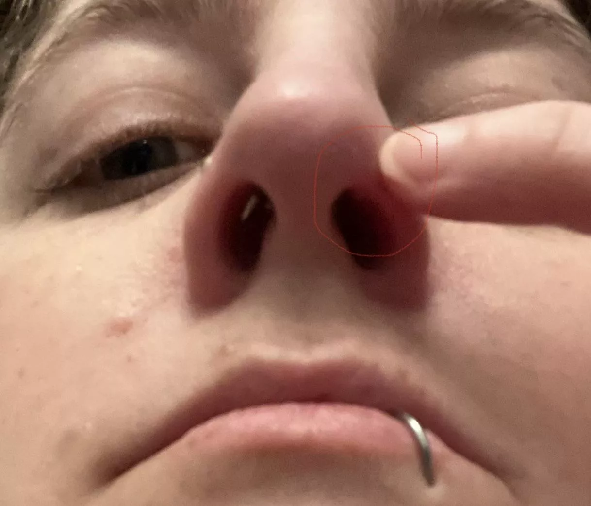 Forbidden Pimple Placement