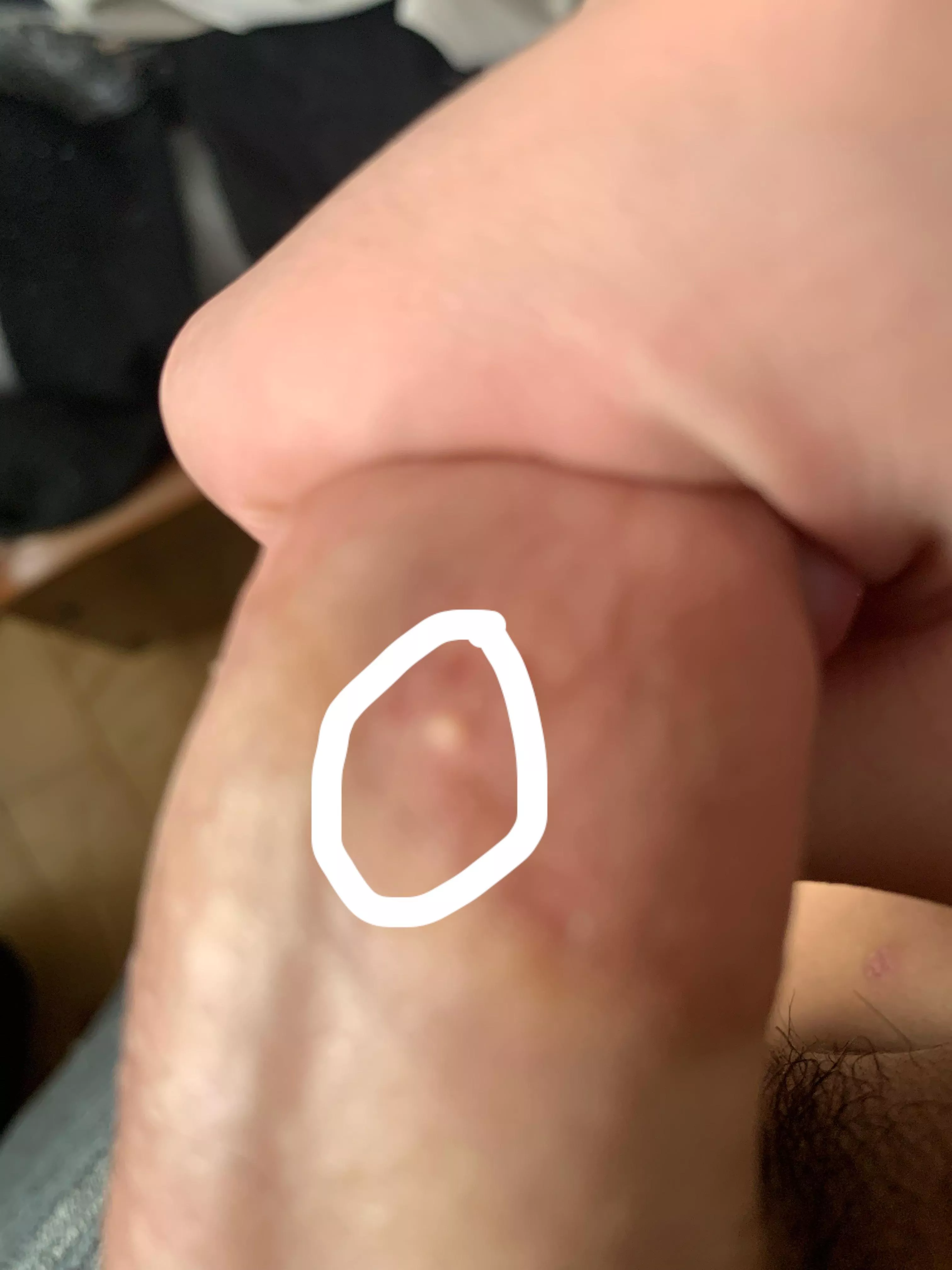I have this white bump on my penis it just appeared it’s hurts when it touch it. I’m pretty sure its a ingrown hair but idk pls let me know