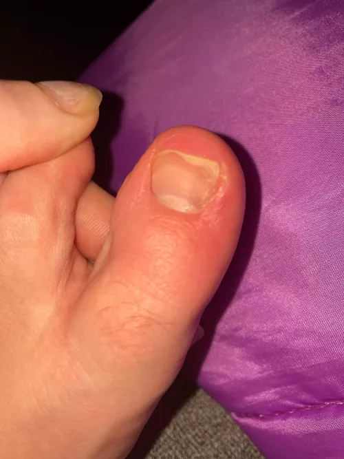 Paronychia or Ingrown Toenail?