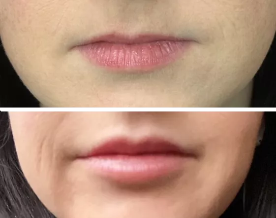 Wife's upgraded lips. What do you think?