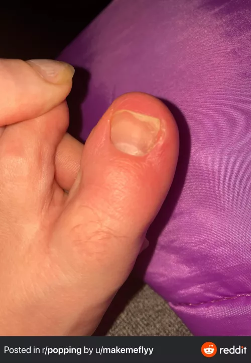 Waiting for it to rupture. I just need a whitehead.