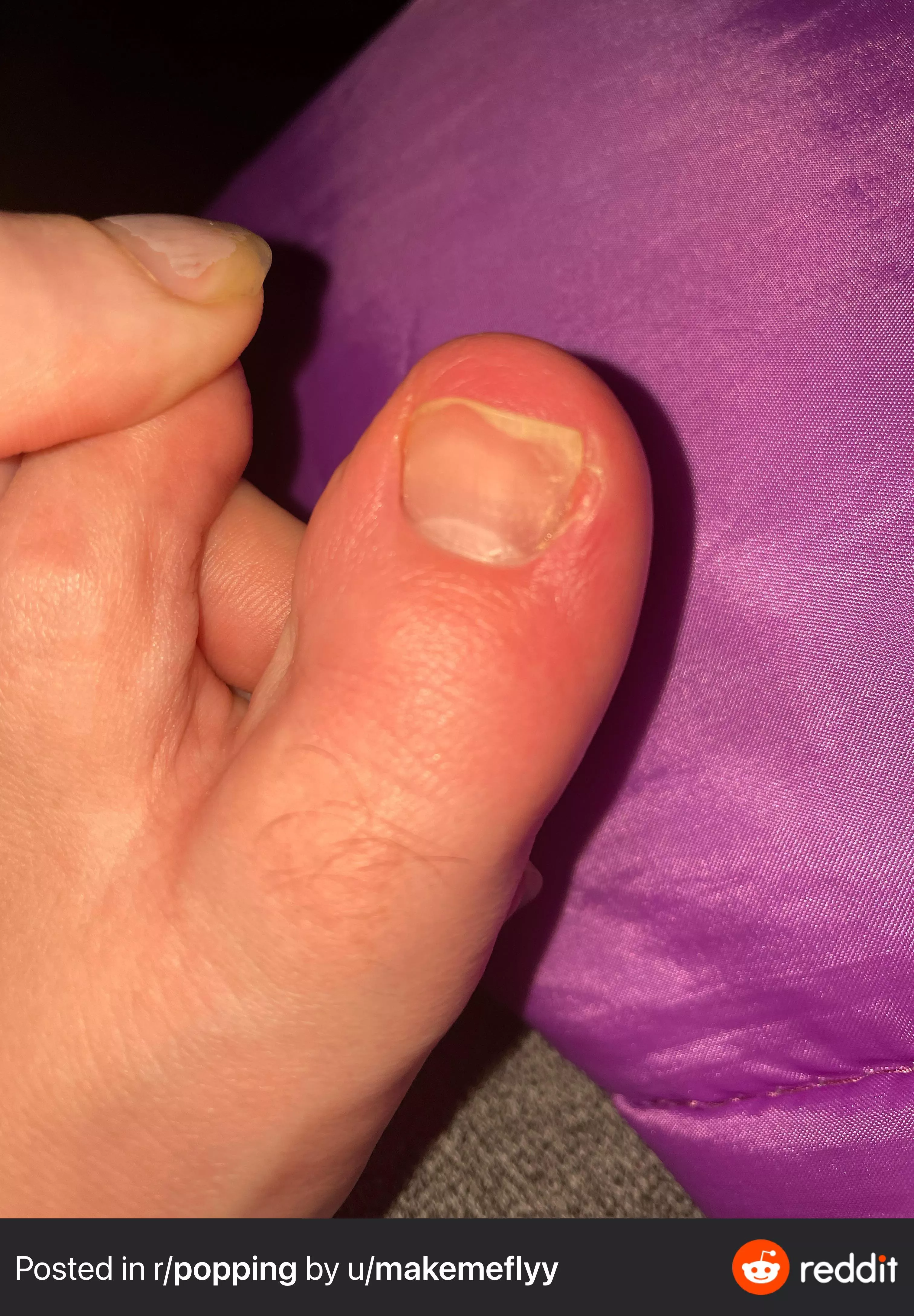 Waiting for it to rupture. I just need a whitehead.