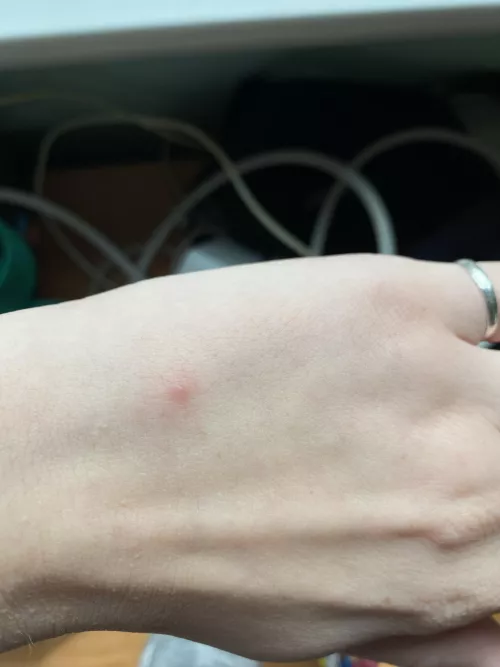 Bite? Pimple? Rash? I don’t even know what this is but I’m so tempted to pick at it!