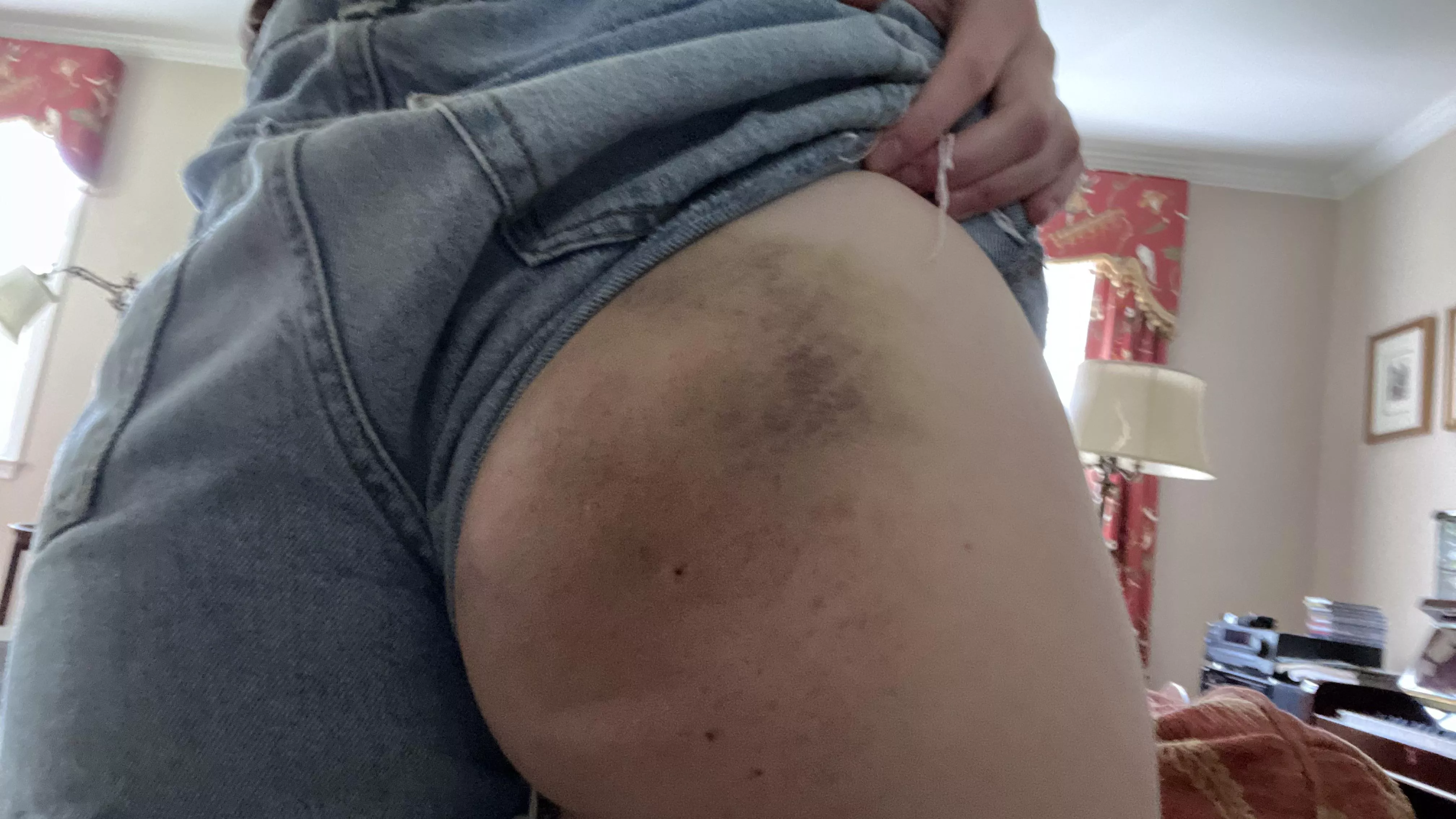 Don’t you love the bruises after a nice paddling?