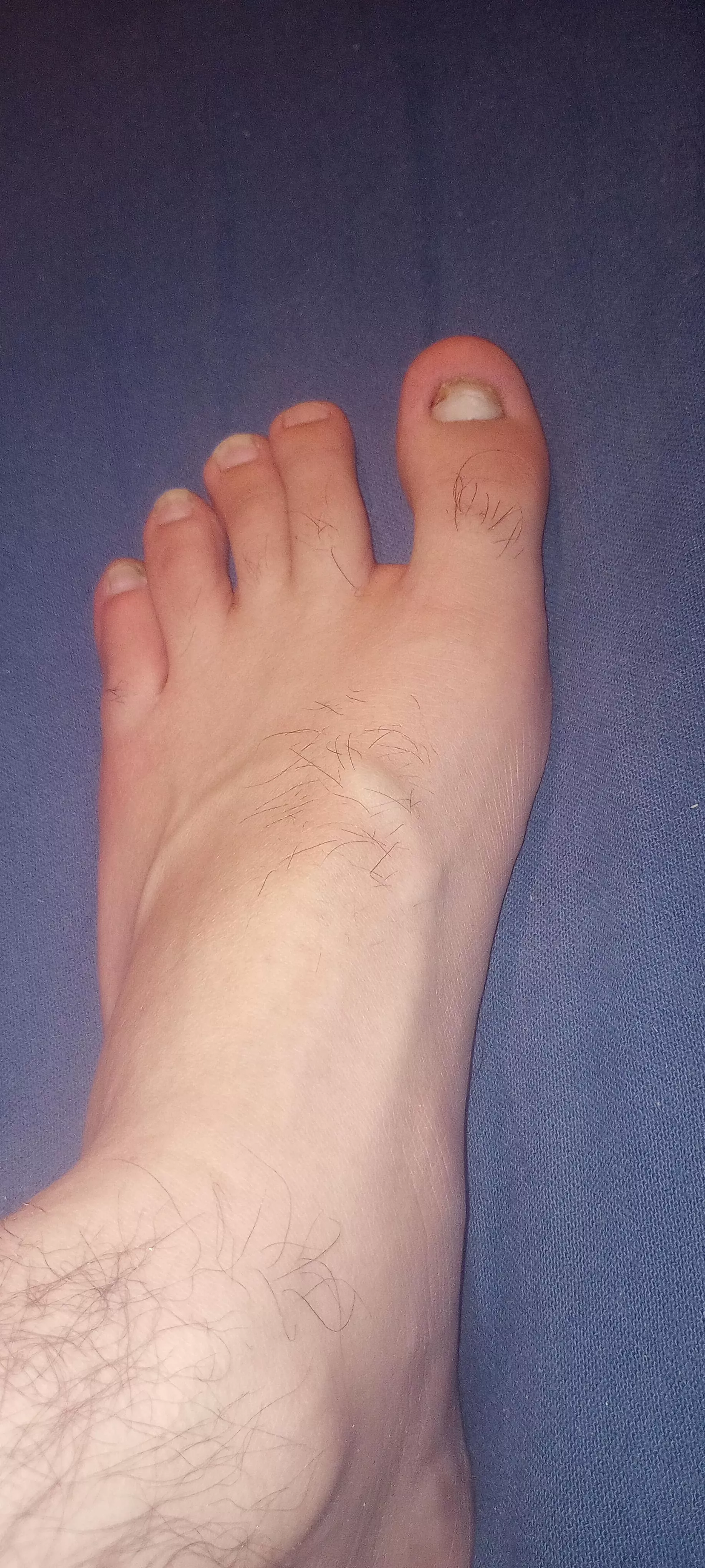 lost my big toe nail. Anyone want to kiss it better. DMS Open!