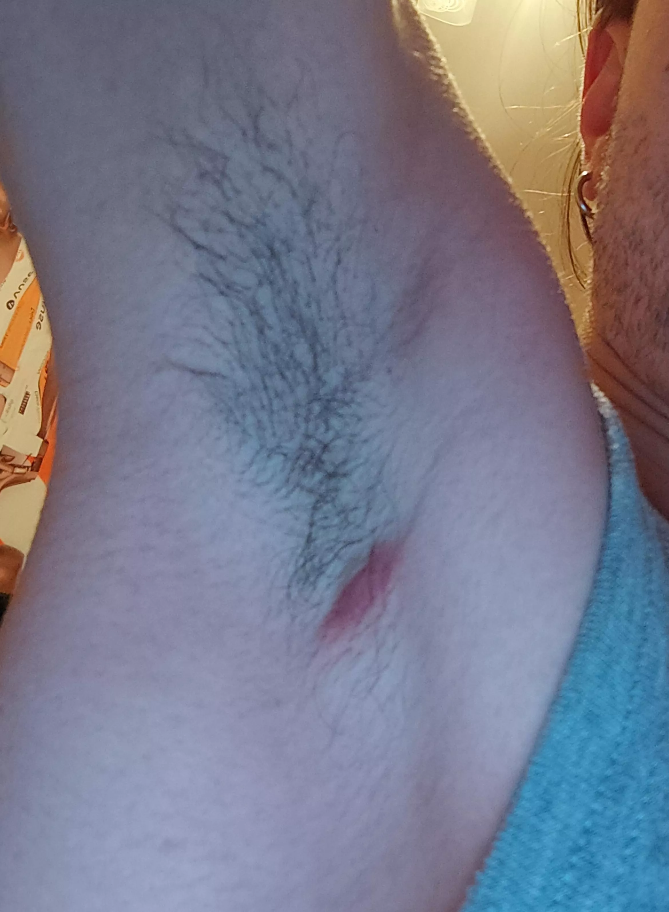 What do you think it is? And more importantly, should I prick it with a needle?