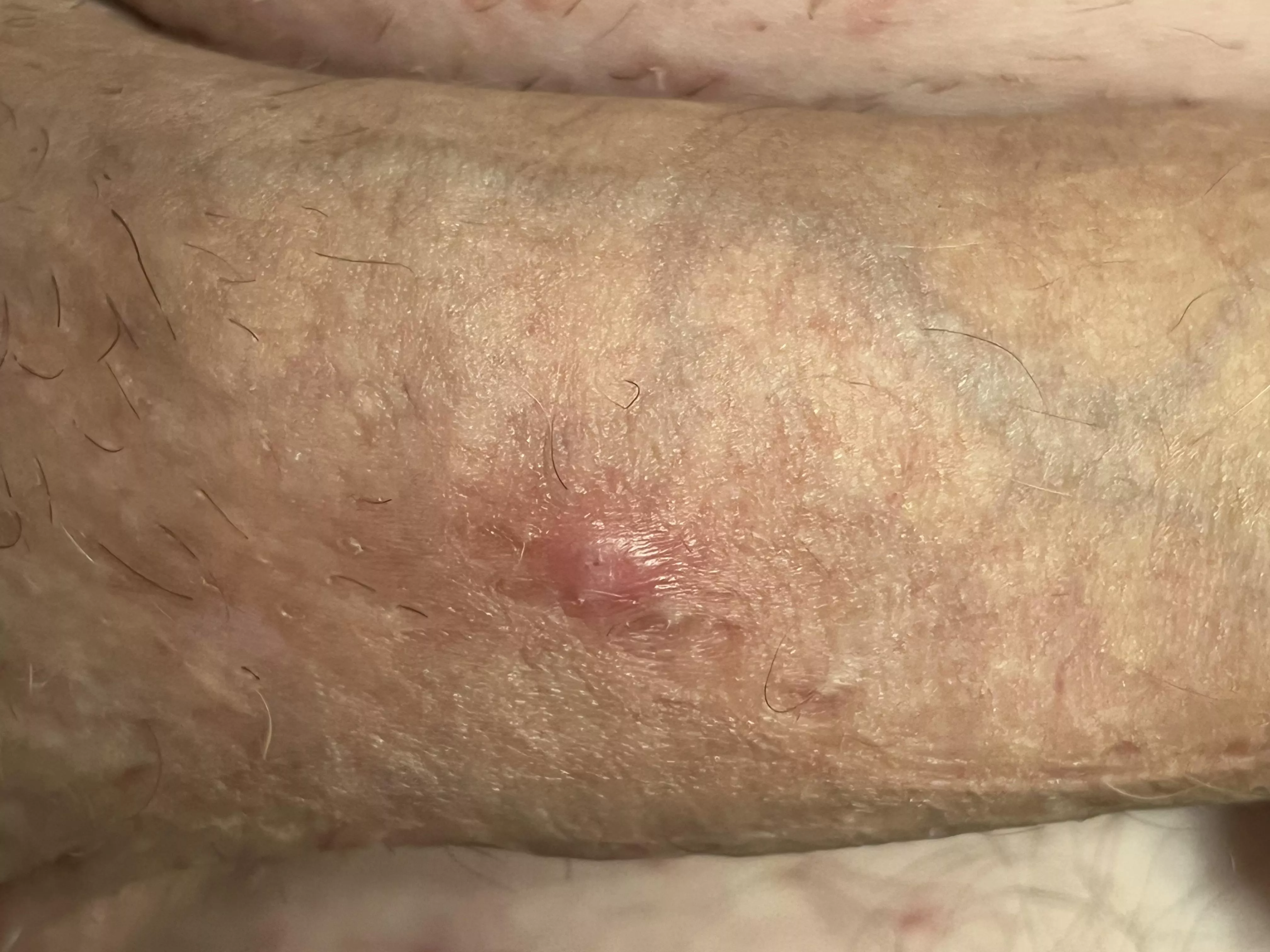 Any tips to remove this ingrown hair on my penis before it gets too bad