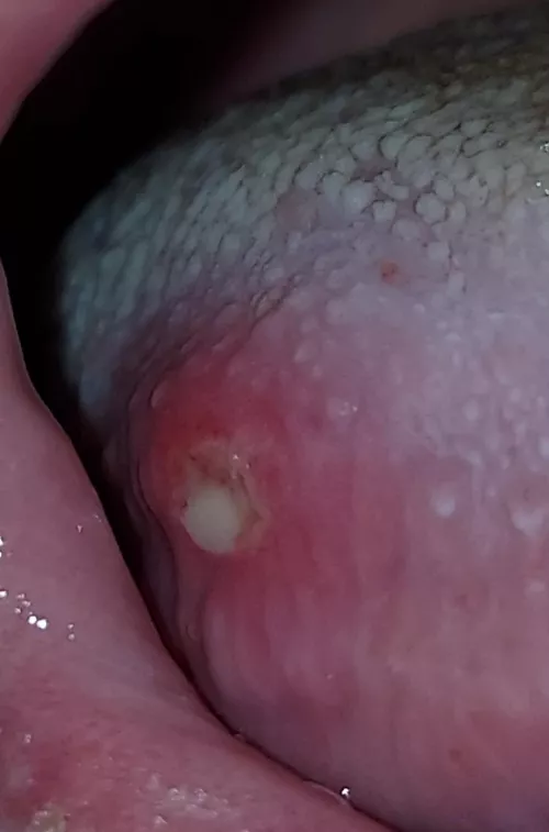 What is this spot on my tounge? It's been driving me crazy since saturday!