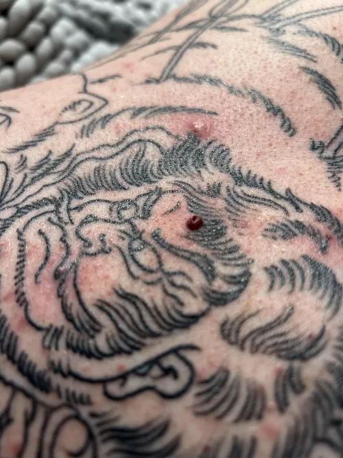 Blood blister or something else?