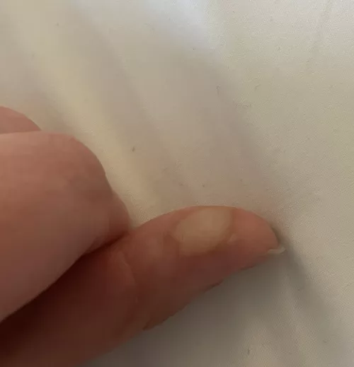 Forbidden, deep burn blister