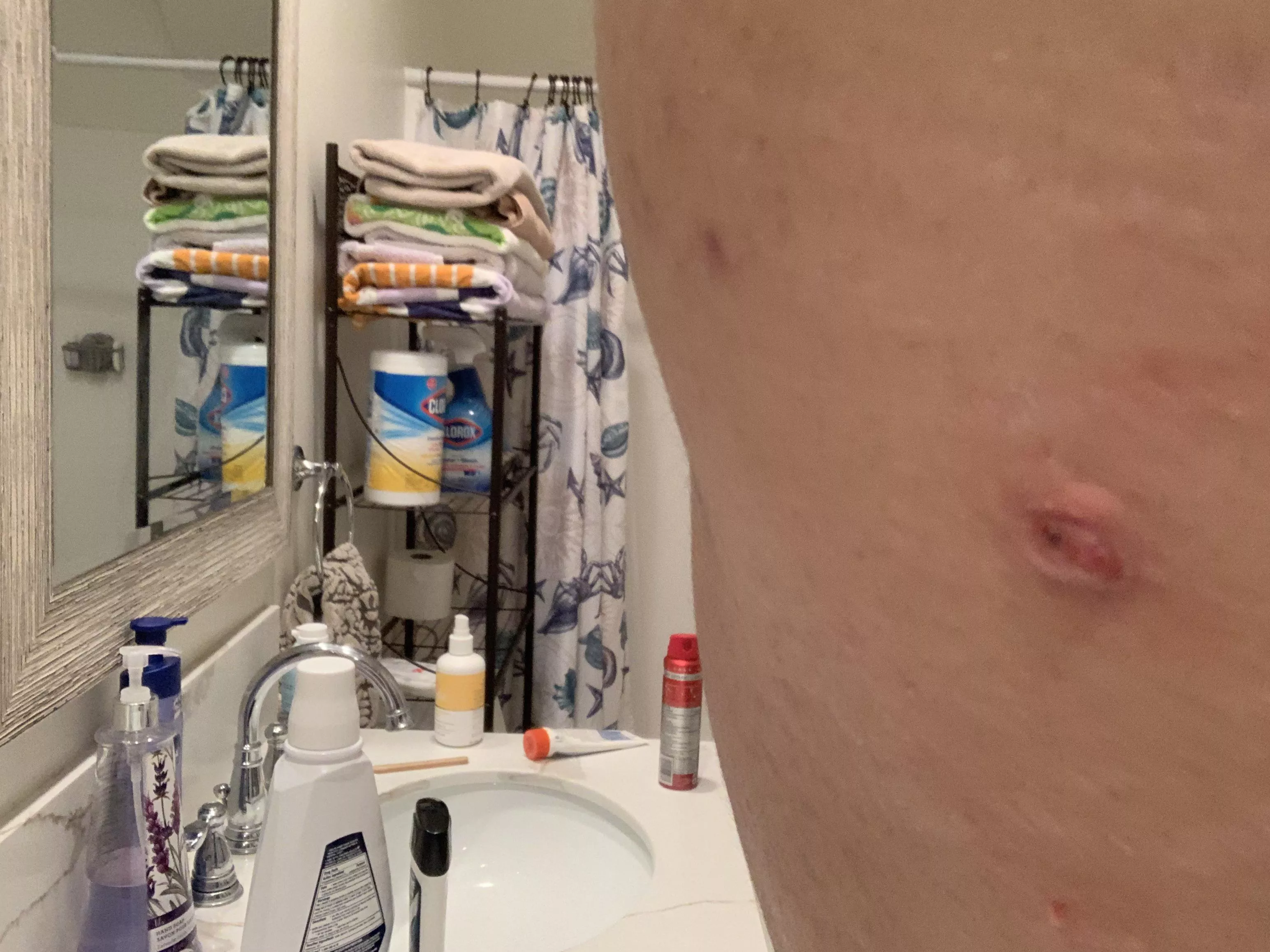 I found this weird looking boil/cyst looking thing on the back of my arm near my armpit, any idea what it could be?