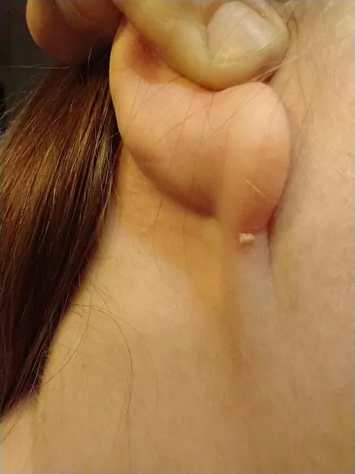 felt some soreness, gave a curious squeeze, was rewarded with a small gunk blob