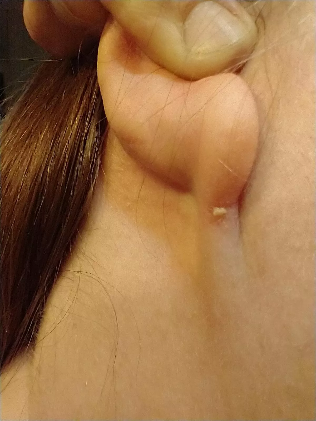 felt some soreness, gave a curious squeeze, was rewarded with a small gunk blob