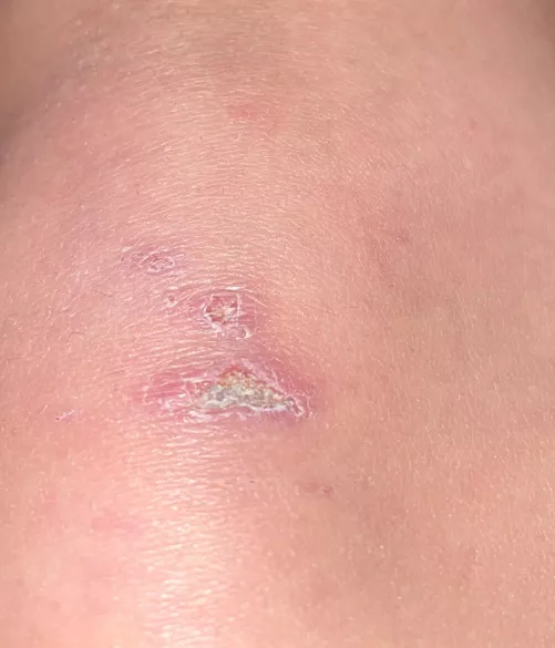 Painful Scab - I'm on day 8 of healing some wounds on both knees and both elbows after falling off a motorbike. This scab is causing me a bit of an issue. No pus but tender and itchy. Any advice or is this looking normal ?
