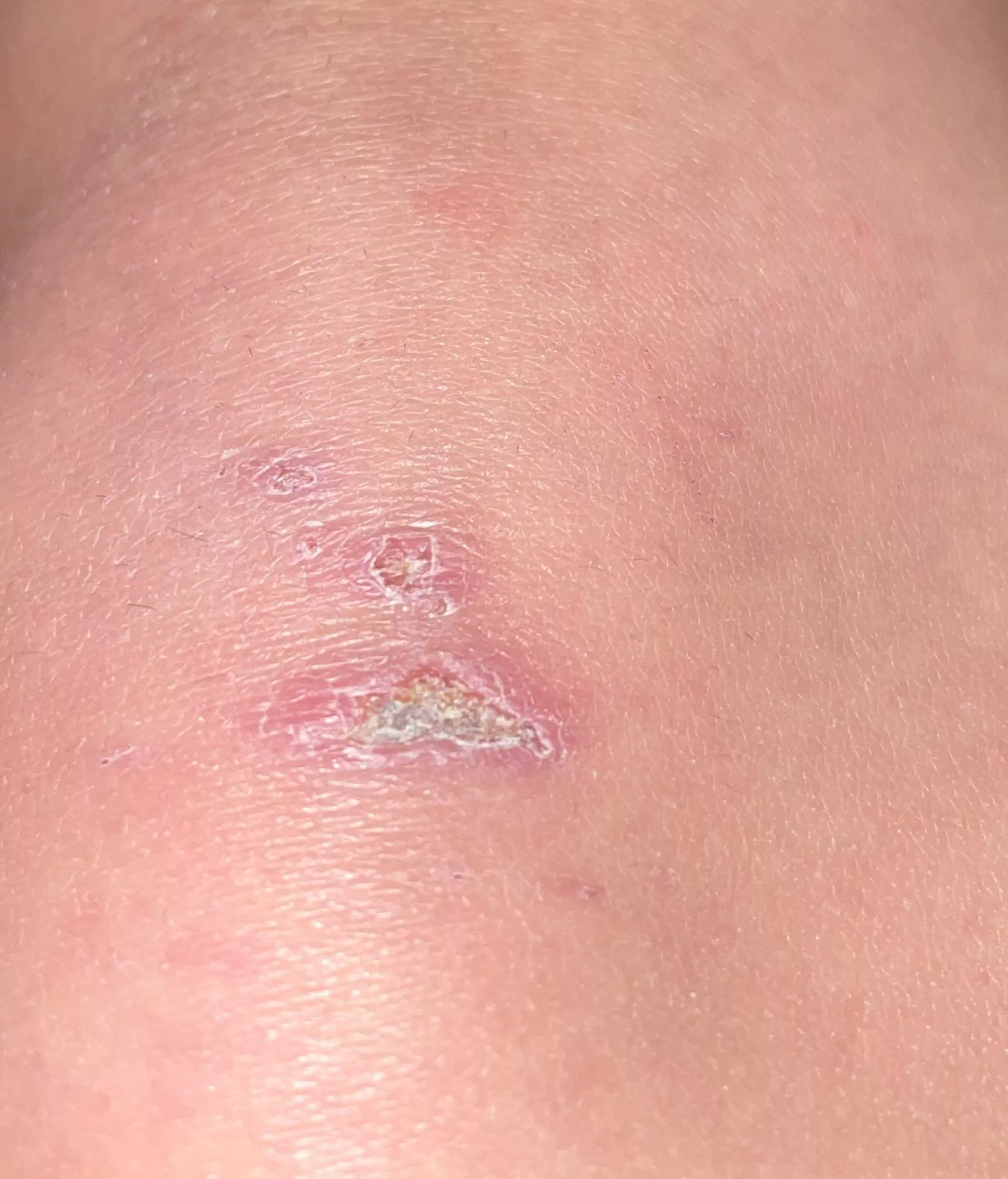 Painful Scab - I'm on day 8 of healing some wounds on both knees and both elbows after falling off a motorbike. This scab is causing me a bit of an issue. No pus but tender and itchy. Any advice or is this looking normal ?