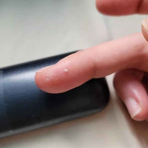 Cut my finger with broken glass over a month ago. It was still very sensitive even after scarring. Then a tiny bump appeared - just plucked this tiny piece of glass out. Relief