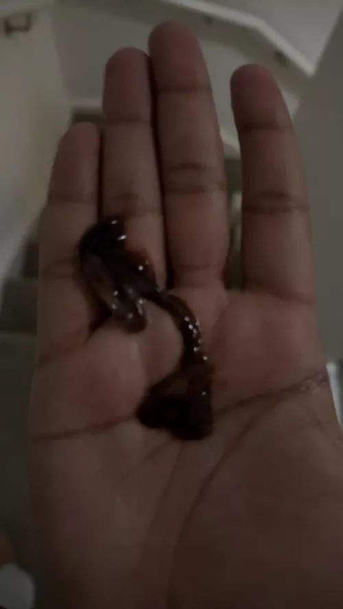 Massive blood clot from bose