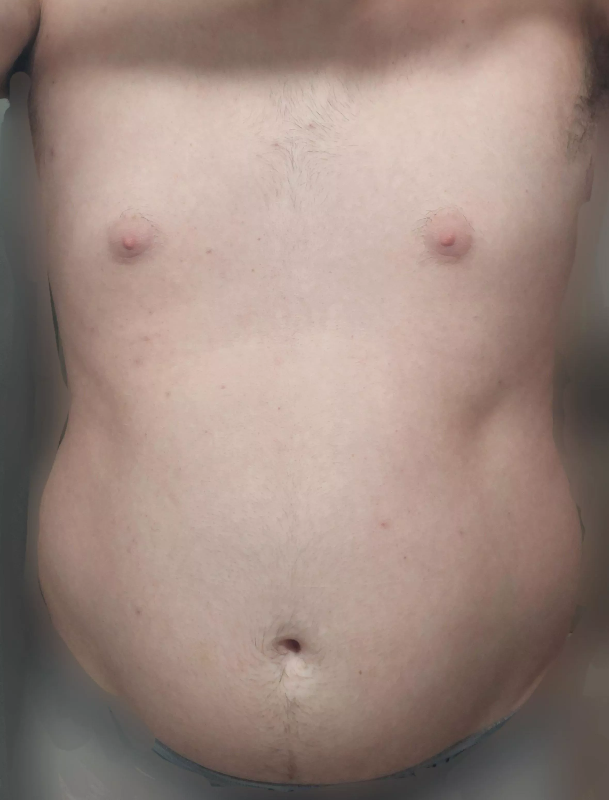 Any with/had this type of fat distribution? I don't really like it.