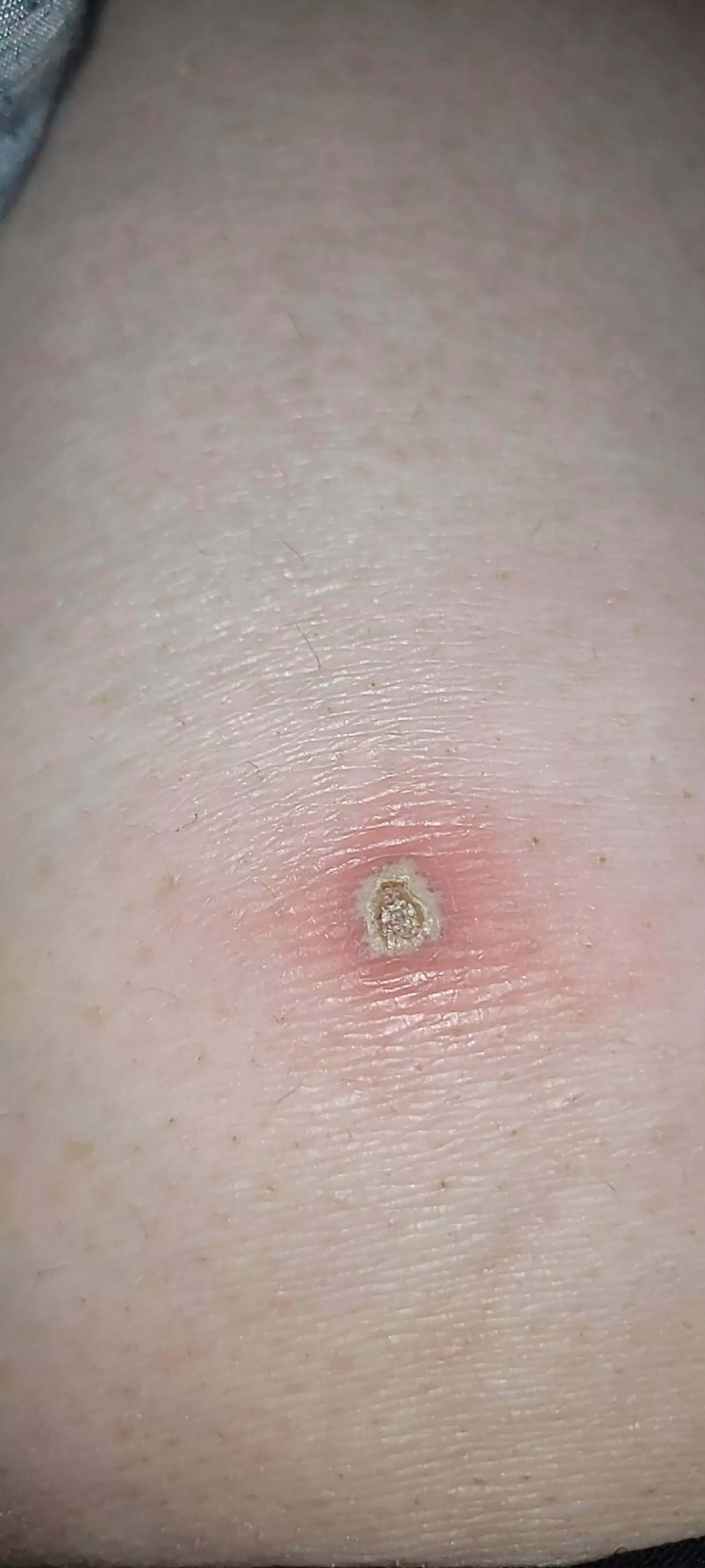 I've come across my own popping hazard... 🤦‍♀️