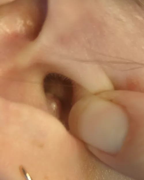 Double-headed inner ear pimple. Husband has been waiting to pop it for me. I can't wait any longer!