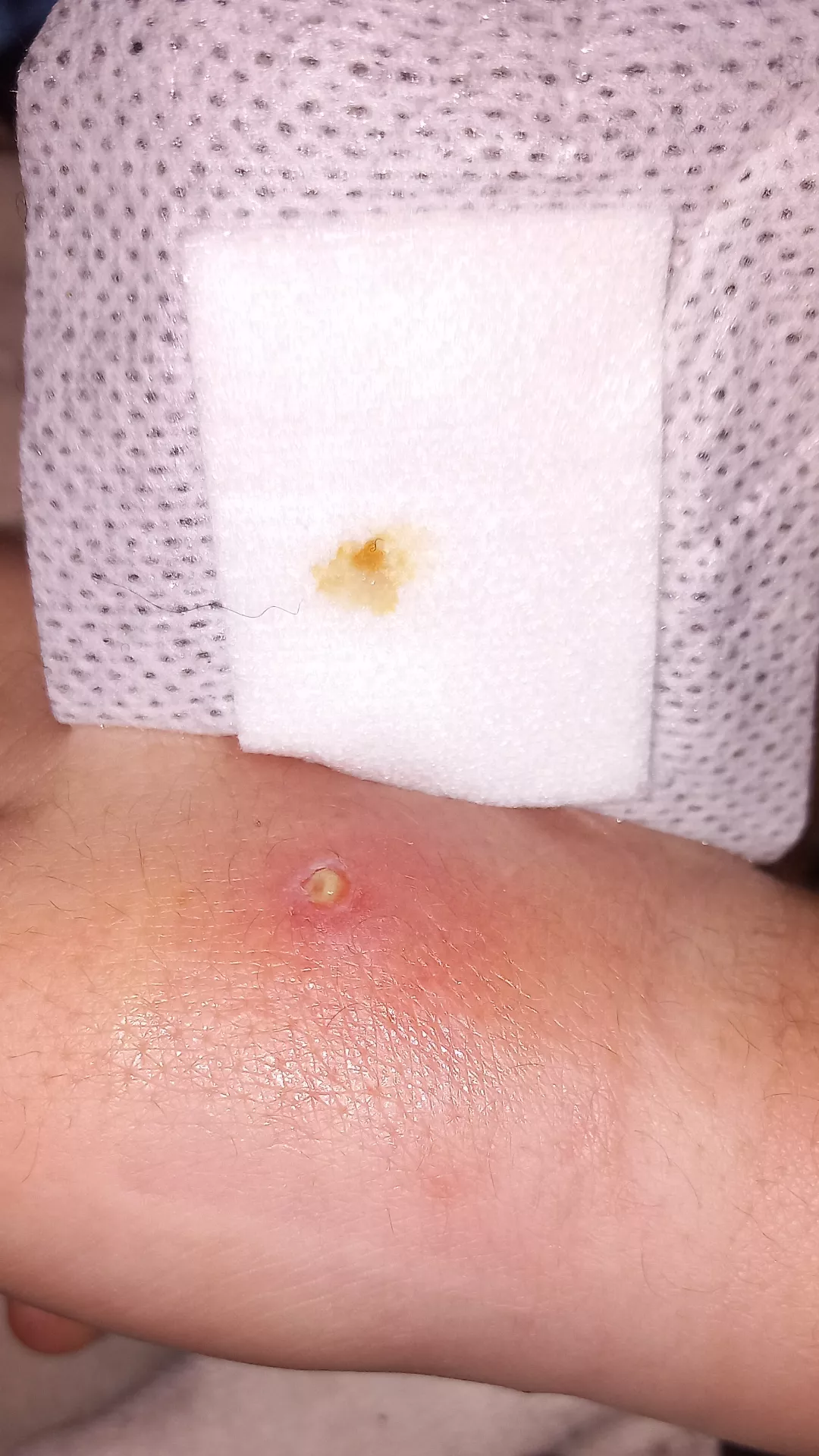 Forbidden pop (I'm on antibiotics & seen a doctor)