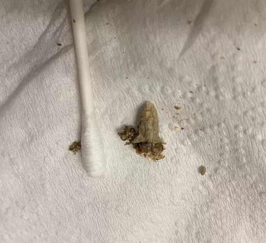 I thought my belly button was clean until I realized how deep the canal went…. After days of trying to reach it with tweezers and breaking off some pieces, I finally pulled out the rest of this 30 year old belly button stone.