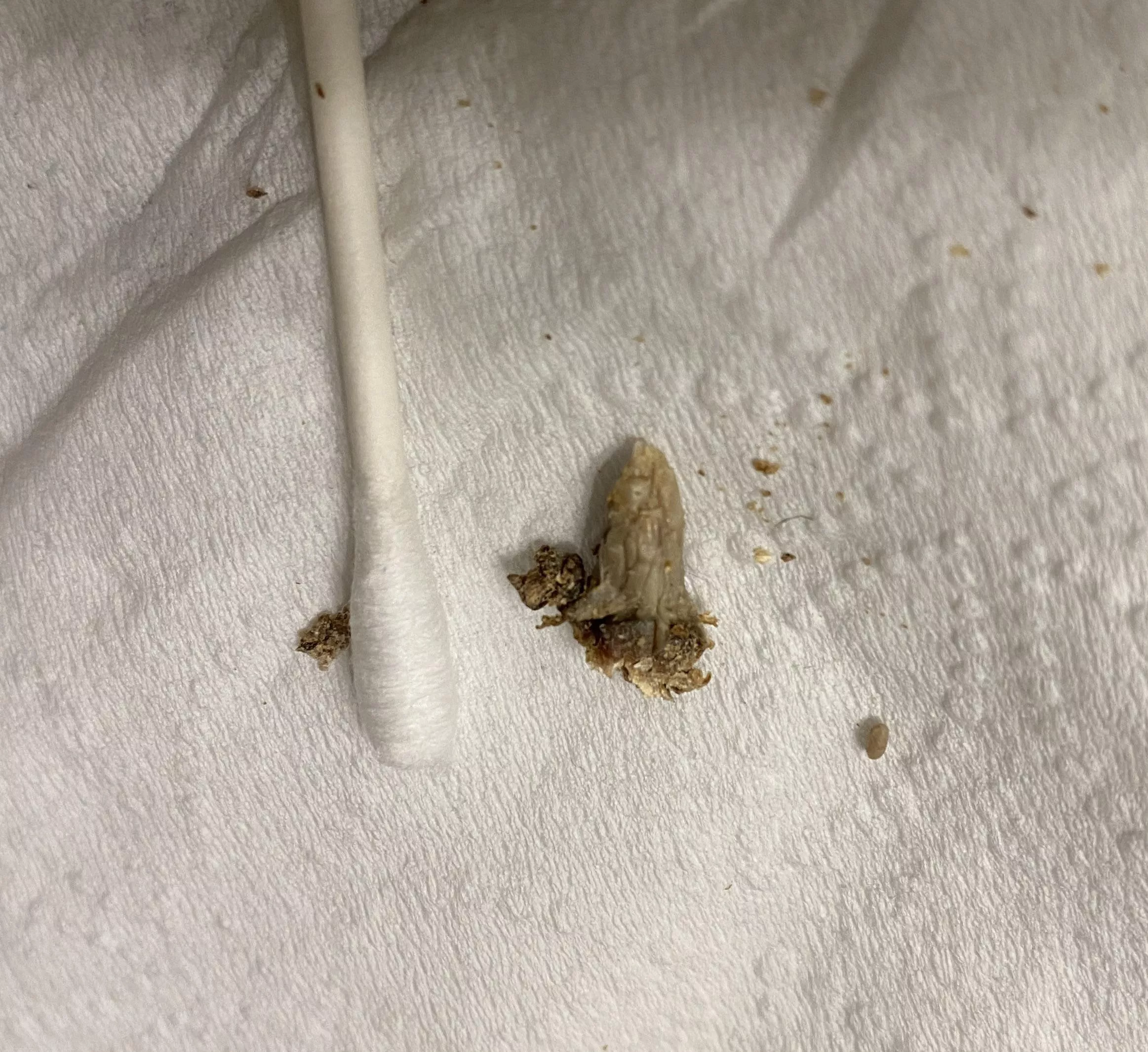 I thought my belly button was clean until I realized how deep the canal went…. After days of trying to reach it with tweezers and breaking off some pieces, I finally pulled out the rest of this 30 year old belly button stone.