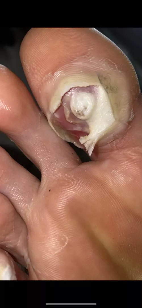 Plantar wart blister popper exposing the inner goodness of the raw wart - any ideas on how to proceed?