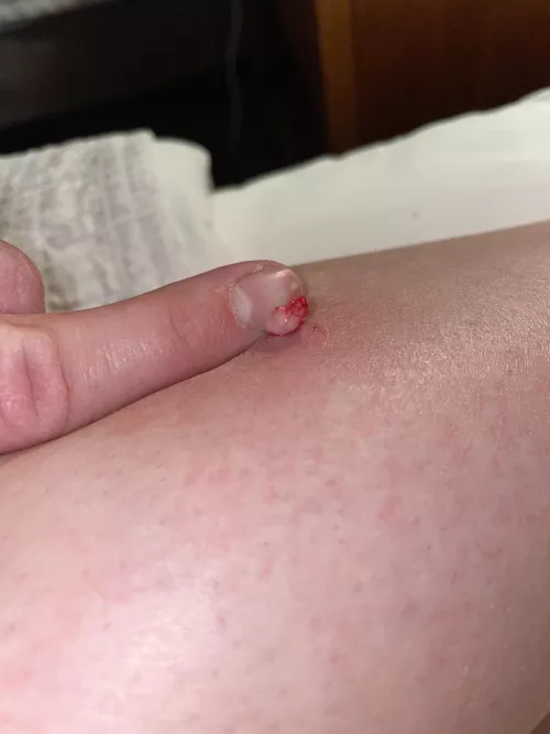 First half of the cyst my girlfriend had in her leg