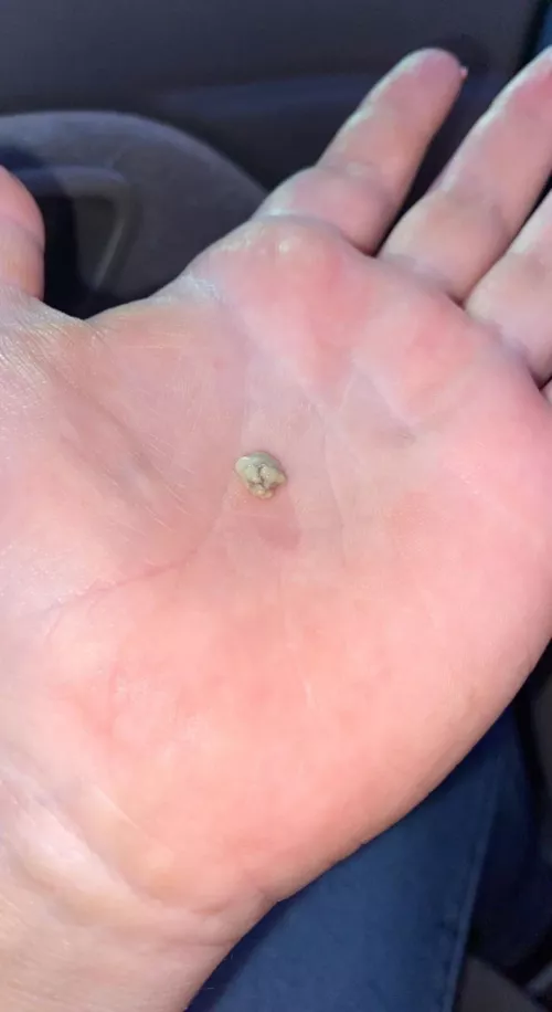 My tonsils were removed 09/22 but I just found this pic of a tonsil stone I had. Yikes.