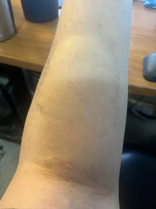 13 years after my “shark bite”