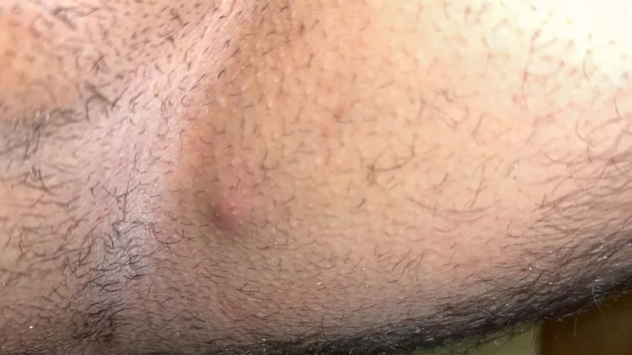 Does anyone know what this is? Groin Area