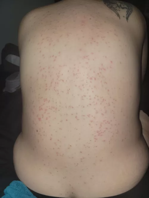 Had an Allergic Reaction to My Meds. Unfortunately It's Way Too Sensitive to Pop.