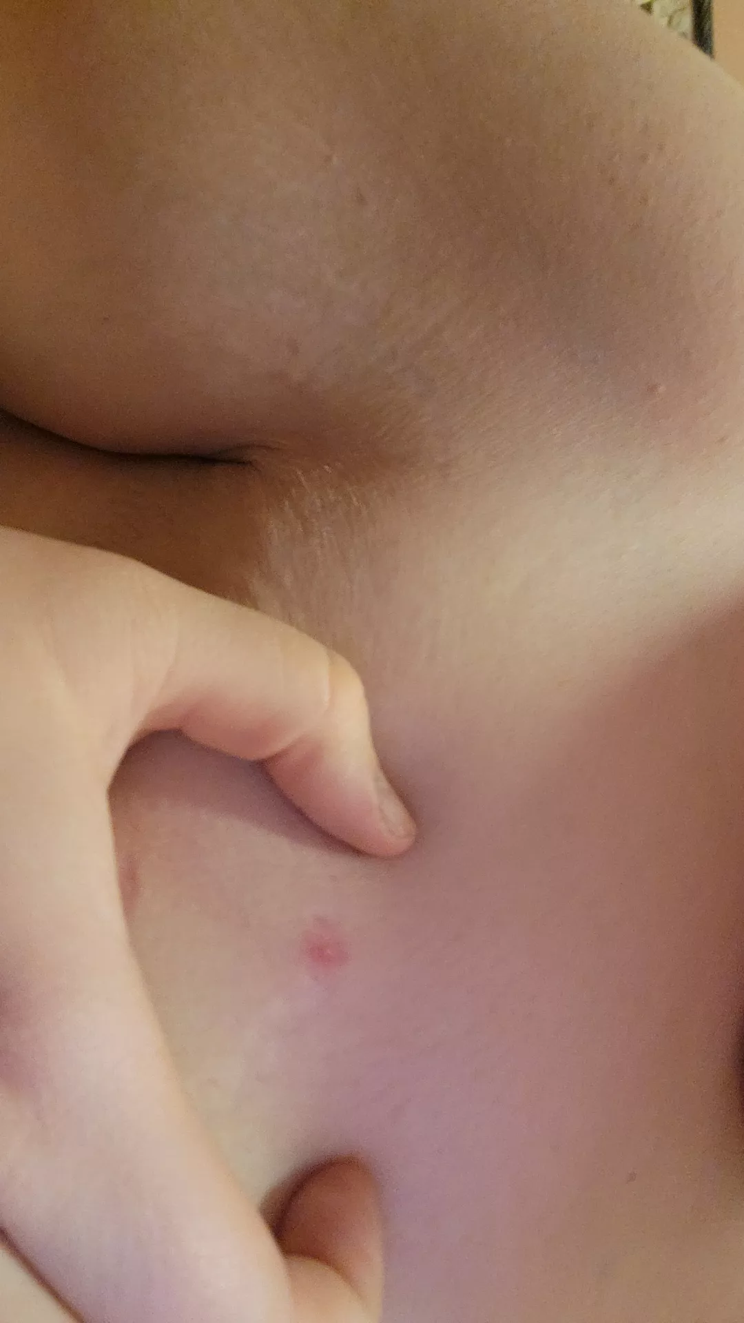 side boob/armpit zit