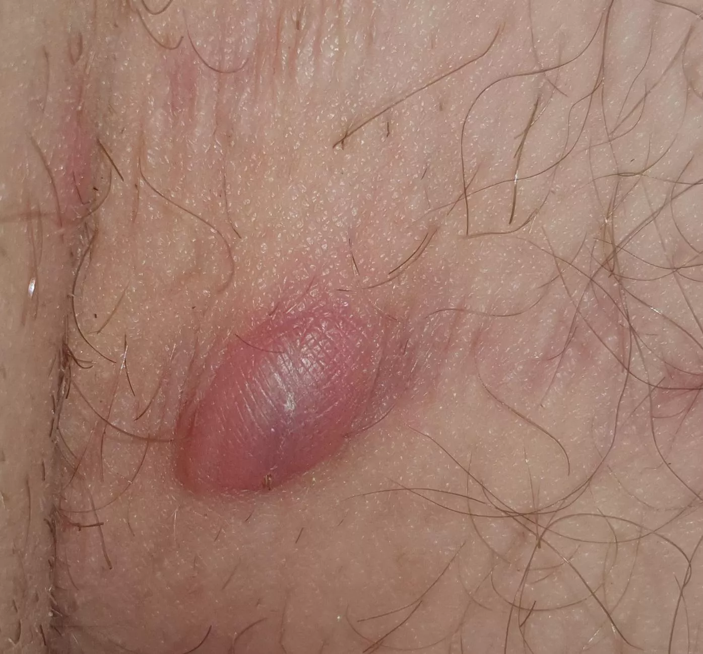 Around 1.2 cm in length, Its located in inner Thigh