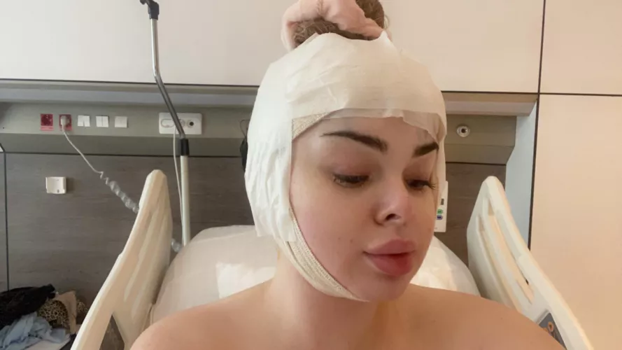 Got a forehead reduction and brow lift today!!!