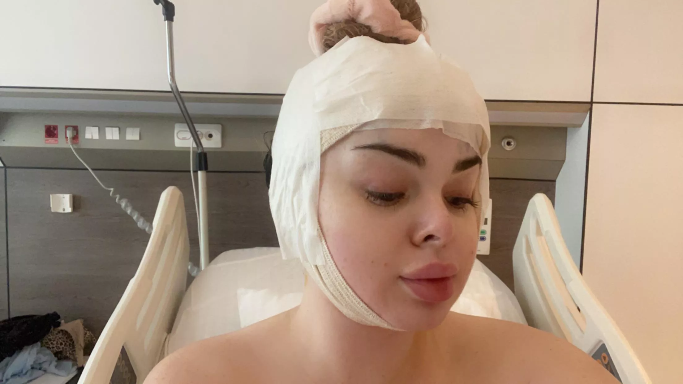 Got a forehead reduction and brow lift today!!!