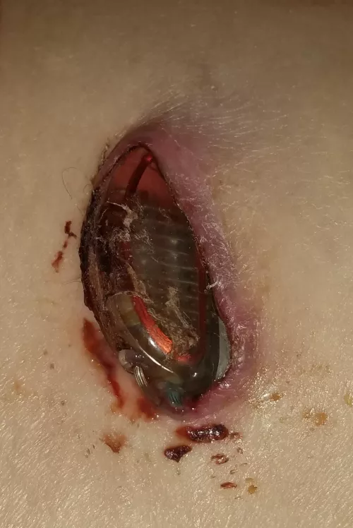 Wednesday Forbidden Pop Medical Implant
