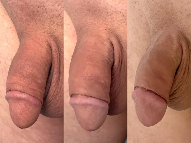 Day 60 / Day 23 / Day 1 (Foreskin Restoration)