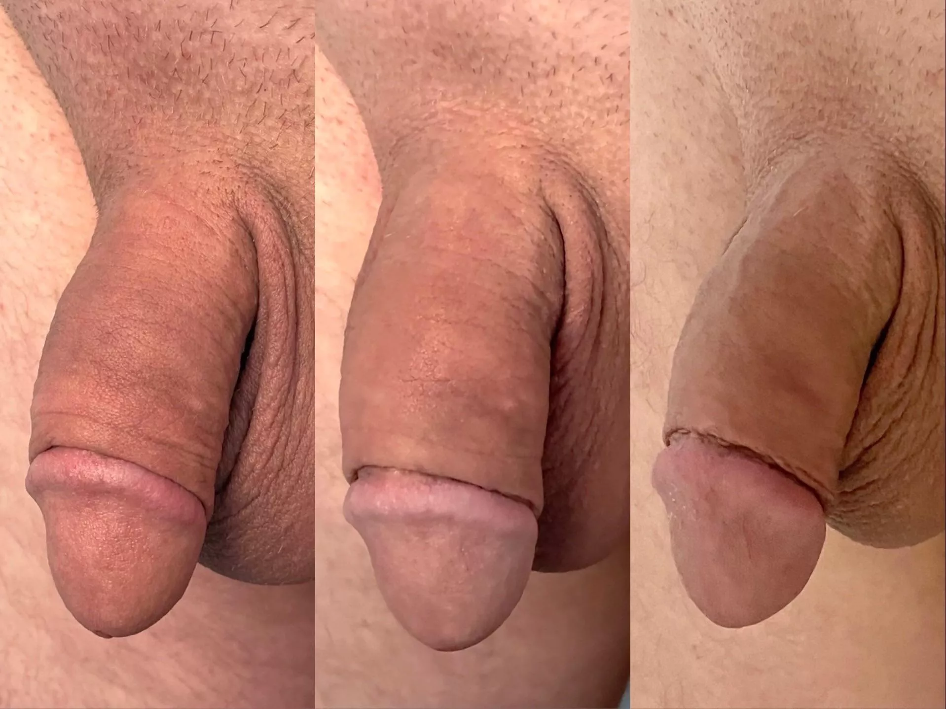 Day 60 / Day 23 / Day 1 (Foreskin Restoration)