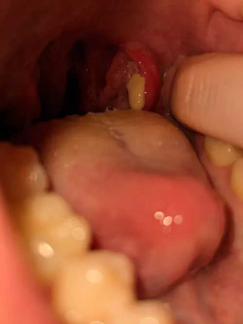 Have had a sore throat on and off for the last 2 months or so. Poked back there thinking it was an inflamed tonsil stone, but turned out to be a peritonsilar abscess. (Sorry for no video, couldn't get the right angle)