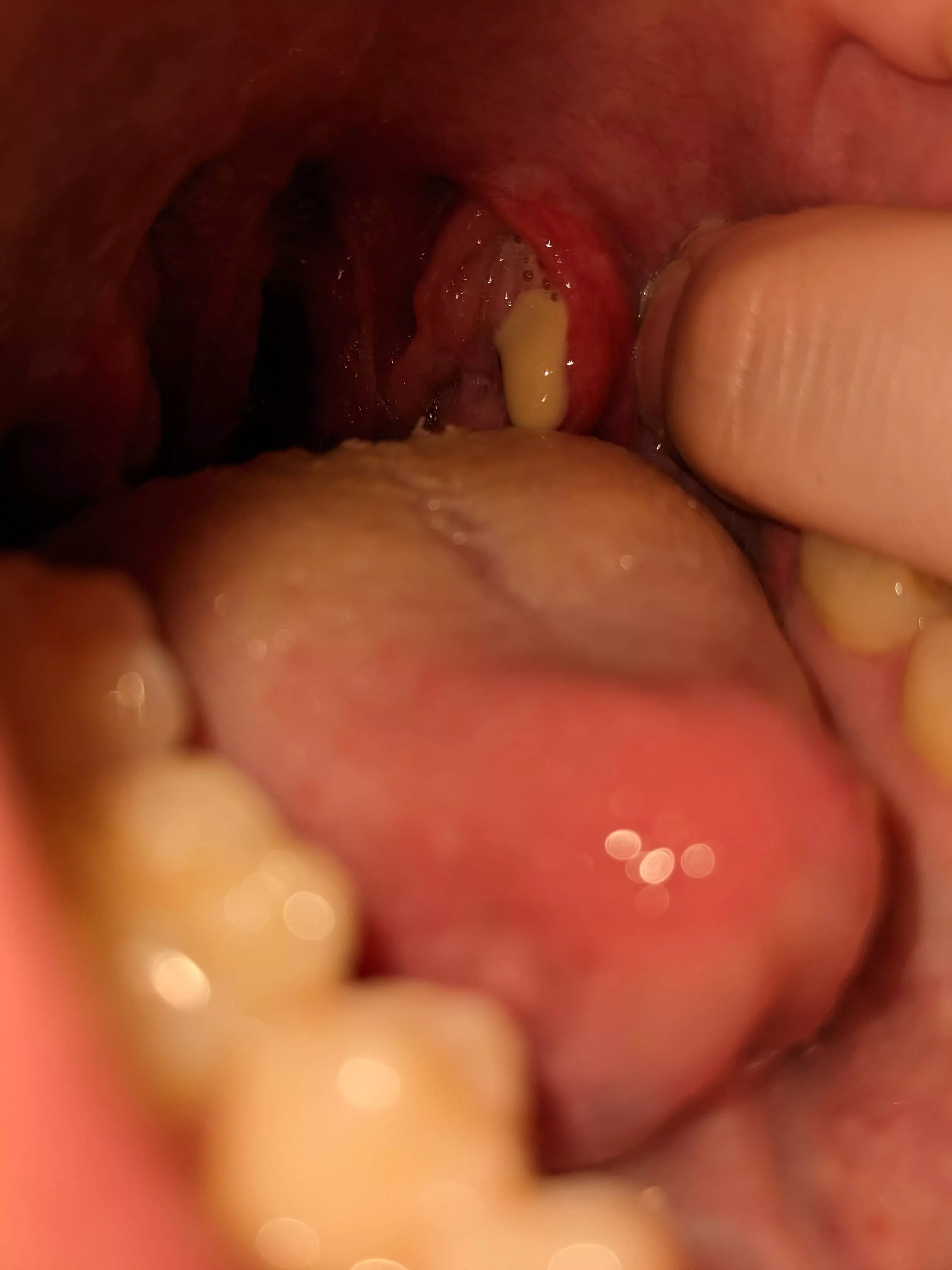 Have had a sore throat on and off for the last 2 months or so. Poked back there thinking it was an inflamed tonsil stone, but turned out to be a peritonsilar abscess. (Sorry for no video, couldn't get the right angle)