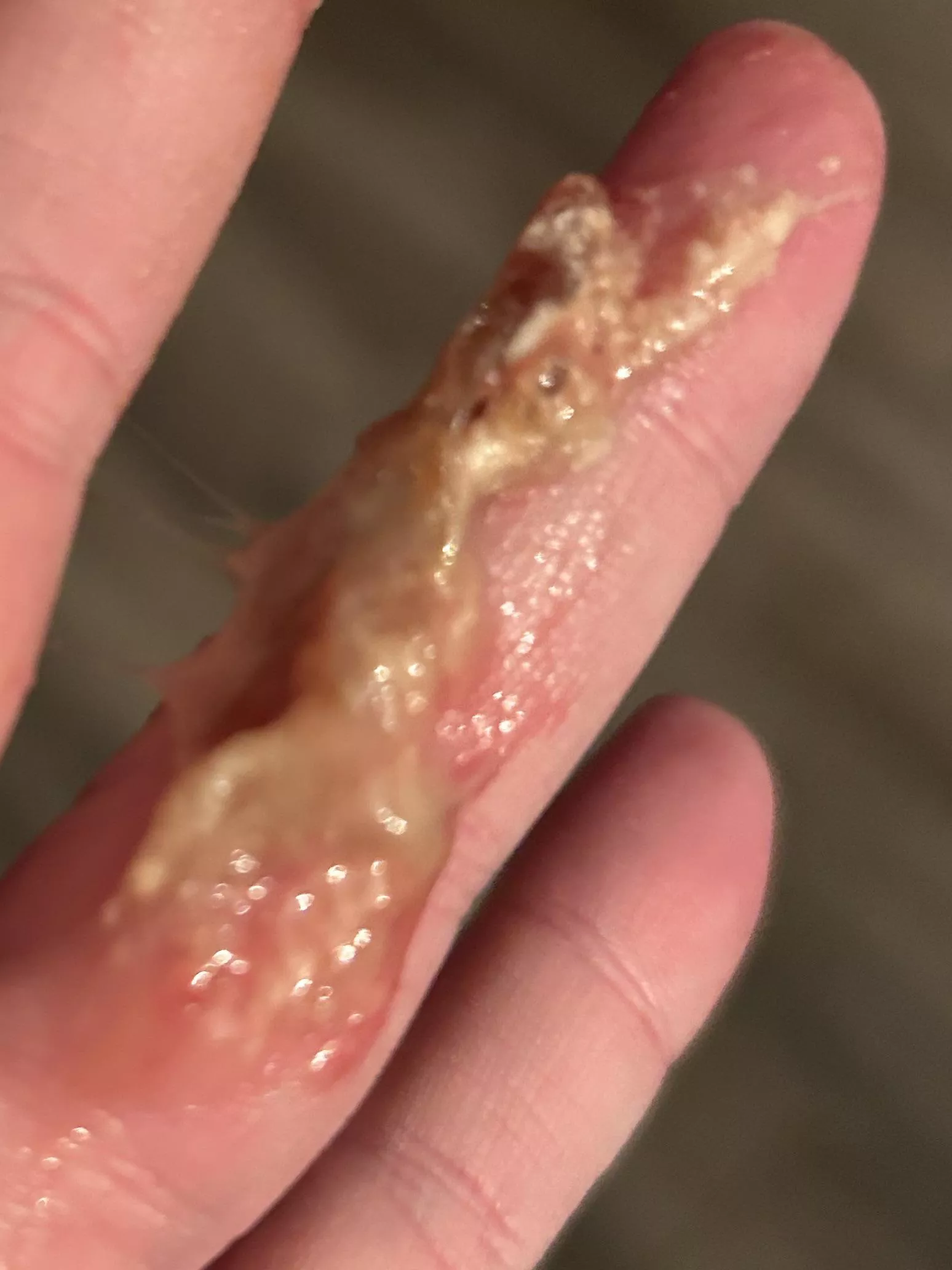 I couldn’t breathe out of my left nostril for 3 days. I would blow my nose and nothing would come out. I went outside in the cold and felt this above my lip. I washed my hands 100 times but not before I stared at it for a while