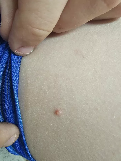 My son has several of these on his inner thigh. The last one I thought was a spider bite because it was red and deep. it turned into cellulitis and he had to get 2 antibiotic shots in his butt. No answer to what caused it. I like to avoid that outcome ag