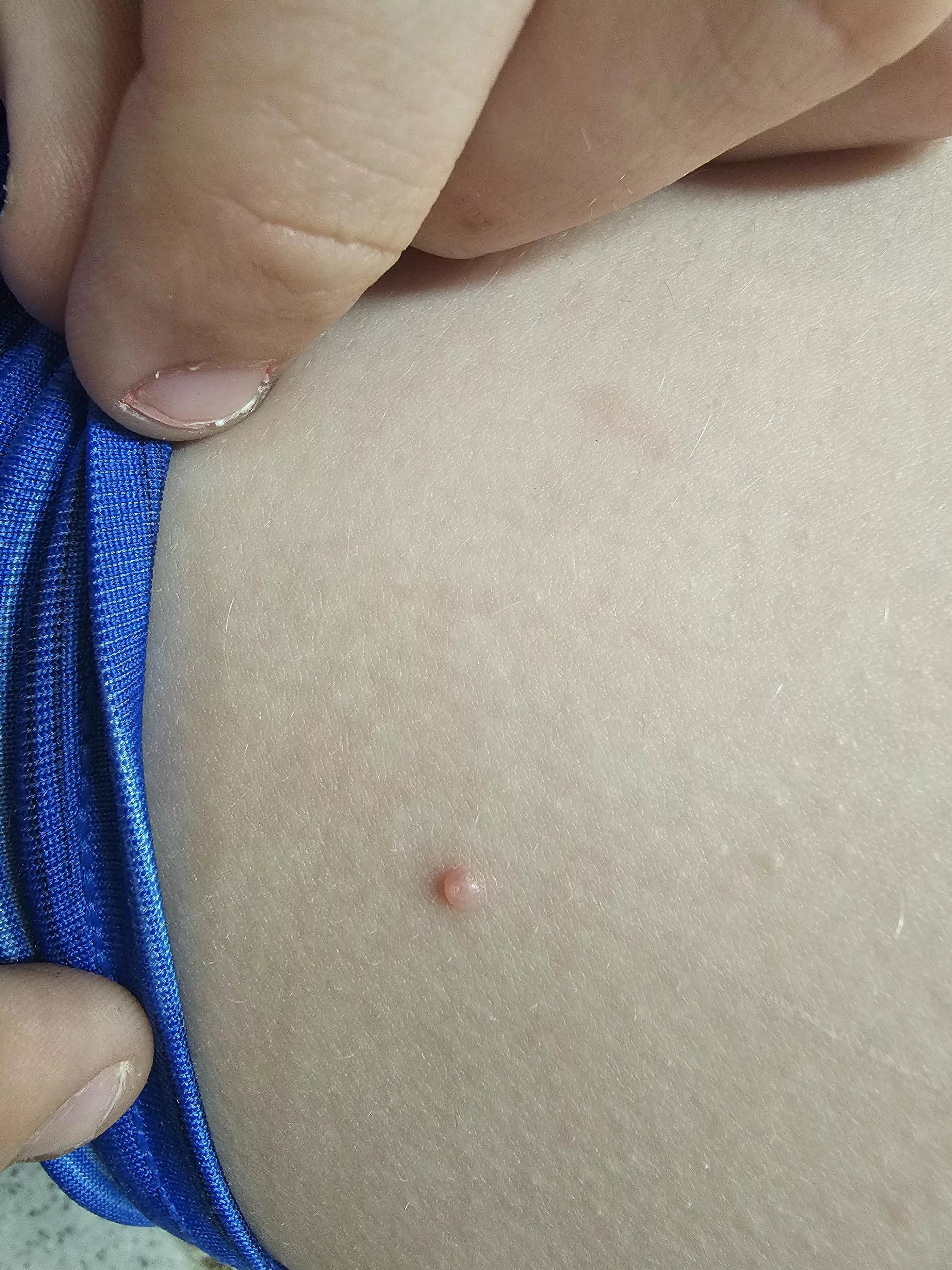 My son has several of these on his inner thigh. The last one I thought was a spider bite because it was red and deep. it turned into cellulitis and he had to get 2 antibiotic shots in his butt. No answer to what caused it. I like to avoid that outcome ag