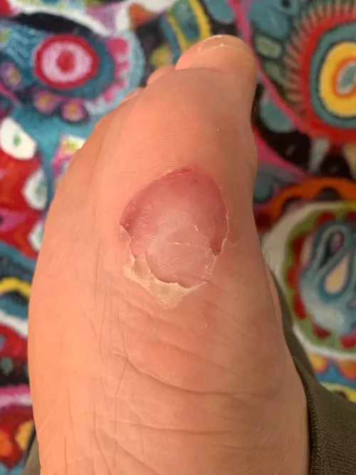 Popped my blister, does it look infected? What should I do