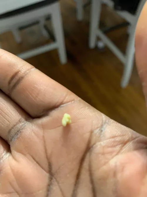 tonsil stone. the second one this week!