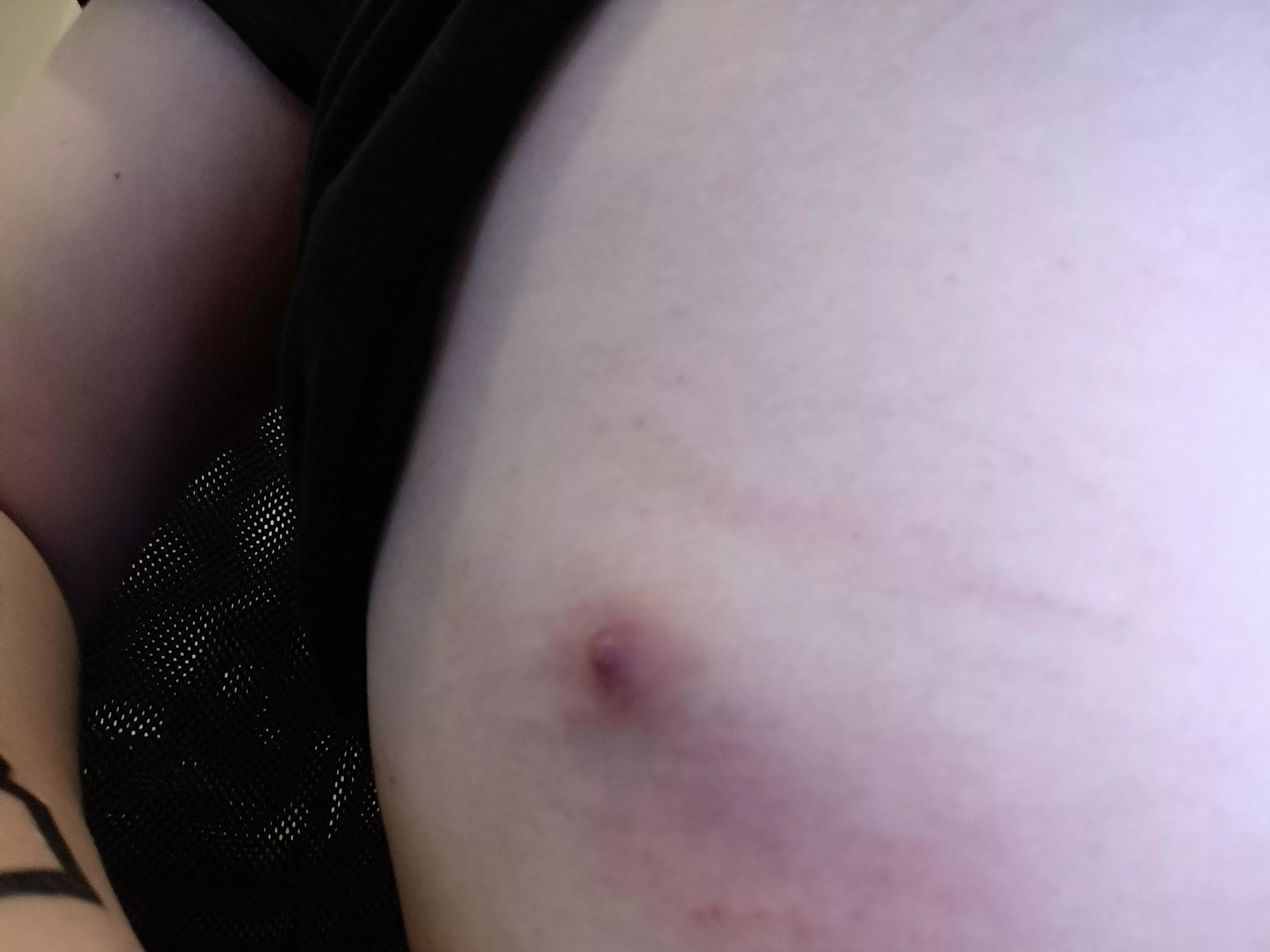 Got this on my side for some days now. i'm taking antibiotics, medic told me it was probably a bug bite that got infected. I'm very tempted to take a needle and puncture it but I'm resising the urge.