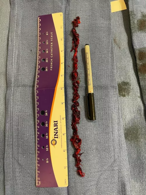 Had a blood clot removed from my thigh