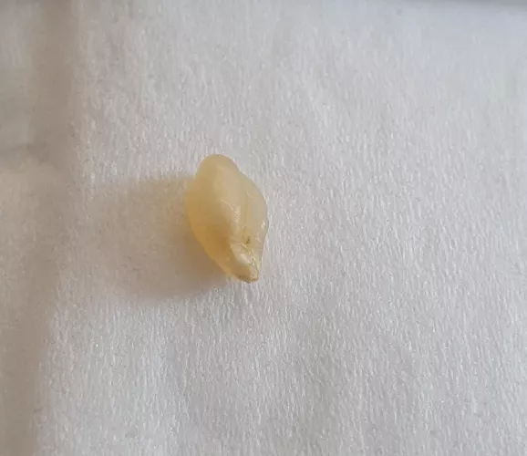 Sebaceous cyst sac just pulled from back of scalp with tweezers. I've had this thing for 10 years and it is finally gone.